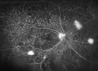 OCT szerokokątne retinopatia cukrzycowa