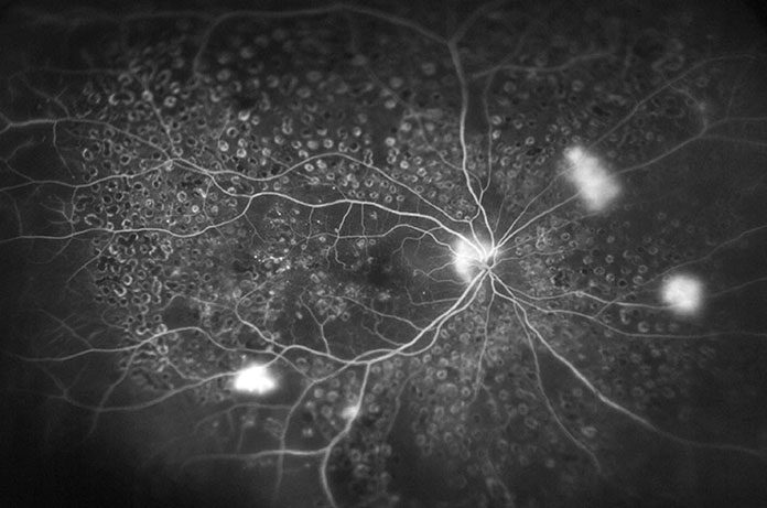 OCT szerokokątne retinopatia cukrzycowa
