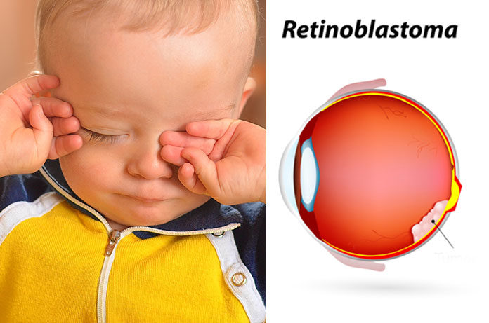 siatkówczak-retinoblastoma